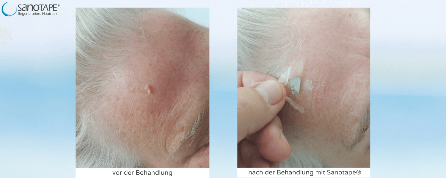 Alterswarzenbehandlung mit Sanotape