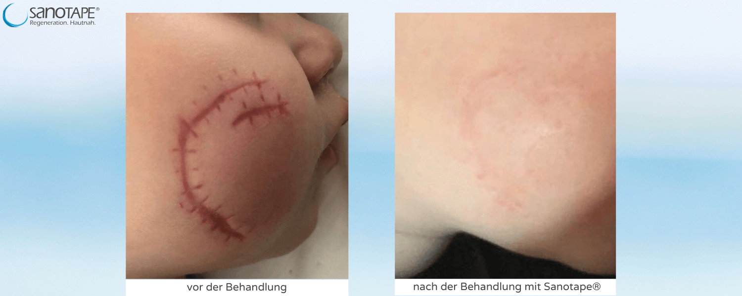 Narbe nach Tierbiss