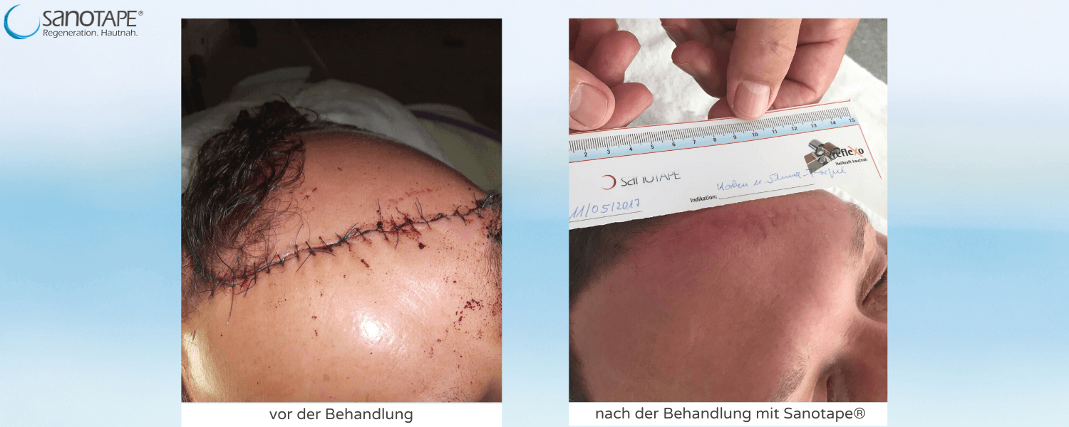 Narbe nach Kopfverletzung