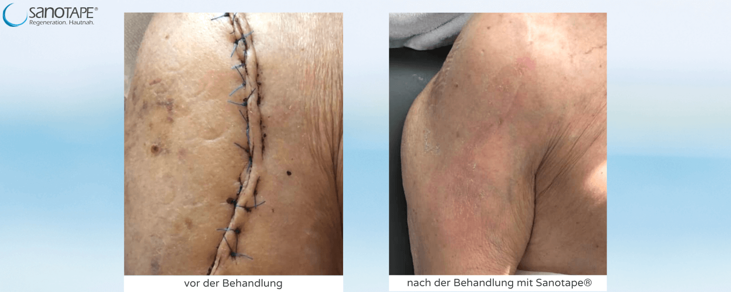 Narbe nach Schulterfraktur
