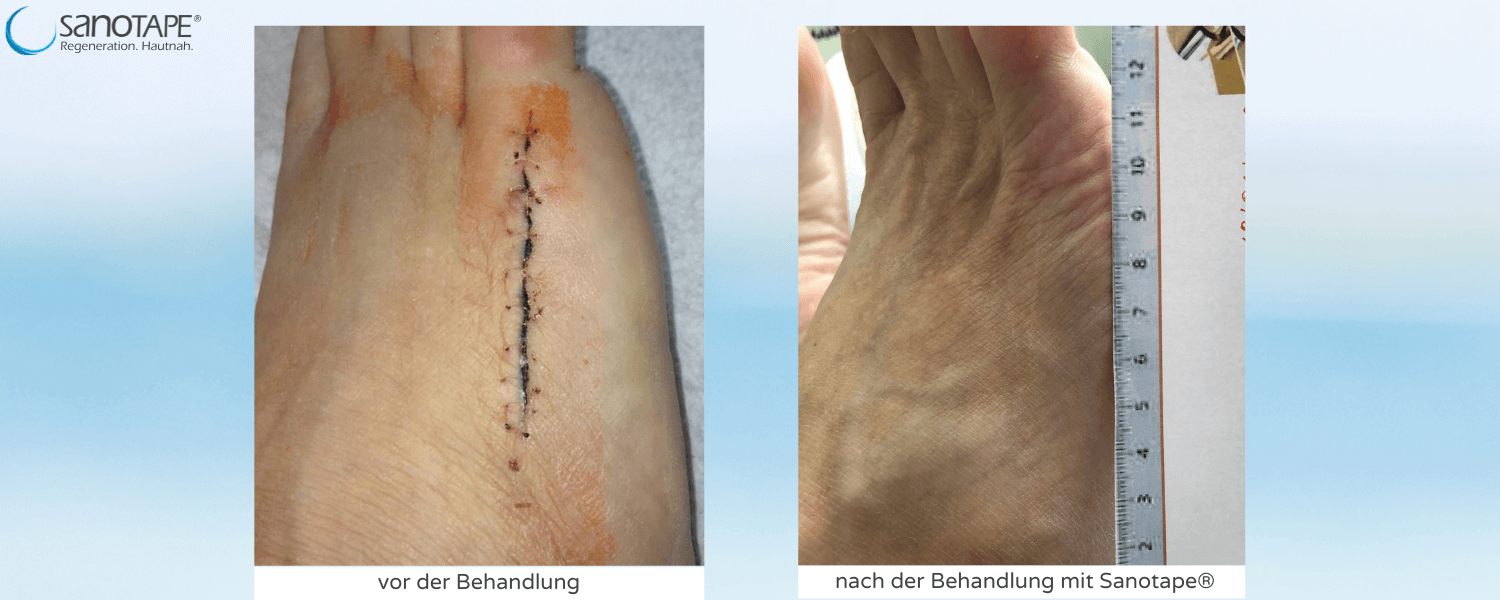 Narbe nach Trümmerbruch
